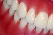 What Vitamins Are Necessary To Avoid Gum Disease